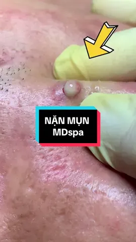 #nặn_mụn #lêthithuydung616 #chuyên_đtri_mụn_rỗ_tpvinh_nghệan #chuyên_đtri_sẹo_tpvinh #mdspa_chuyên_mụn_rỗ_tpvinh 
