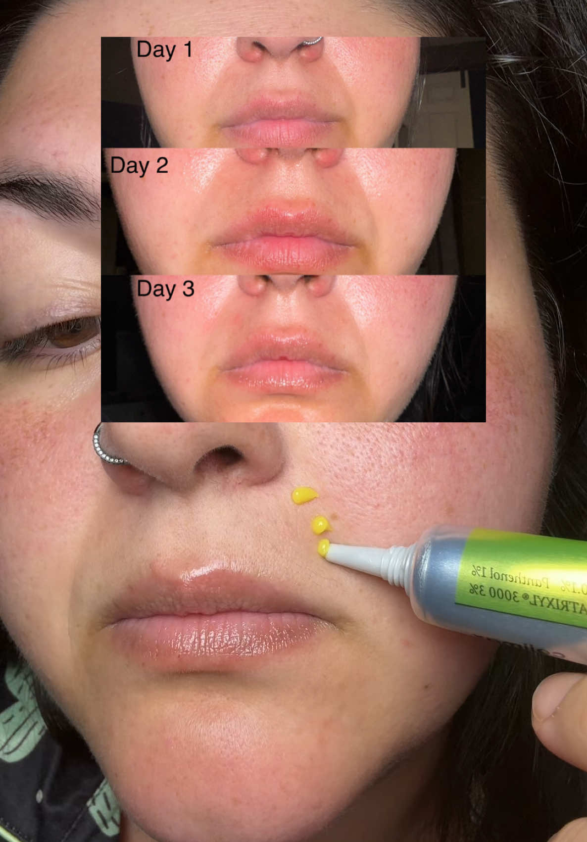 Day 5  #celimax #celimaxretinalshot #retinalshotbooster #retinalshot #retinalbooster #review #day5 #retinalresults #fyp #foryou 