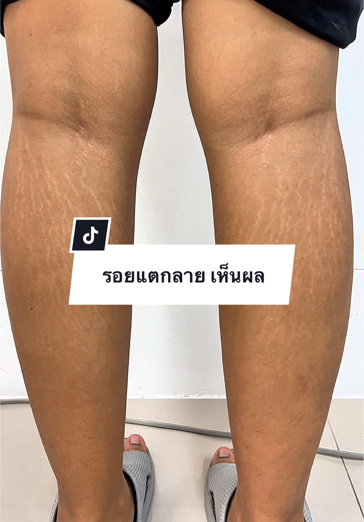 เคสเพียบ 🙏🏻  รอยแตกลายหายได้แล้ววว 🌈 ✅ @aaaa4289 📱098-3288655 📍ข้างโลตัส ลำลูกกา คลอง2  #สอนรักษารอยแตกลาย #เรียนรักษารอยแตกลาย #รักษารอยแตกลาย #ลดรอยแตกลาย #ผิวแตกลาย #เรียนลดรอยแตกลาย #ขาแตกลาย #ลบรอยแตกลาย #เรียนกระตุ้นคอลลาเจน #CapCut 