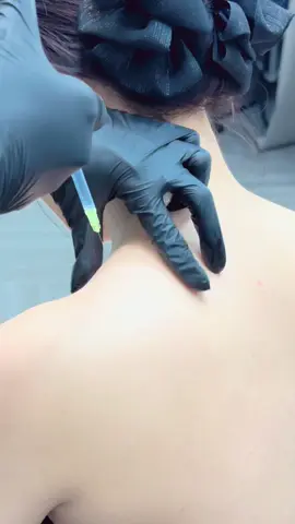 Thon gọn vai sau 1 lần tiêm tự tin mặc áo dây áo cup nè mấy bà yêu oi #moibabylips #xuhuongtiktok #tiemmoifiller 