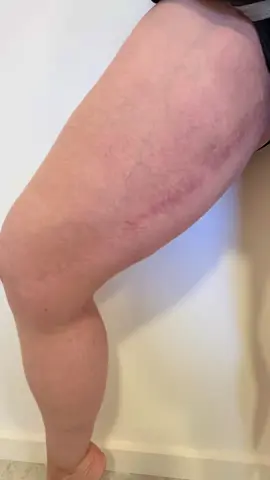 We can make your scars disappear with camouflage tattooing 🖊️ How it works? We match our medical grade pigments to your exact skin tone to seamlessly blend skin imperfections. Want to find out more? Book in for your complimentary consultation today. 💌  #scarcamouflage #scarremoval #perth #fyp #perthskin #stretchmarktreatment #medicaltattooing #foryoupage #stretchmarkrepair #inklessstretchmarkremoval #surgeryscar #excessskin #thighlift #weightlosstransformation  #carti #pbc 