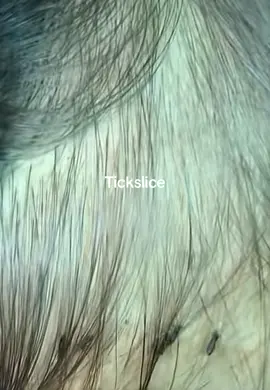 #removalice #lice #tiktokindia_ #omg 