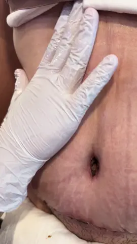 #tummytuck #postopcare #fyp 