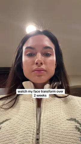 Masseter Botox for the win 👏🏽👏🏽👏🏽 Just a quick note—not everyone is a candidate for this treatment. It’s important to see a provider with plenty of experience treating this area to minimize the risk of jowling #botox #masseter #fyp 