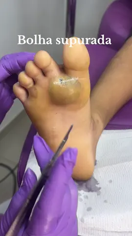 🚨 Alerta Importante: nem toda “bolinha” é o que parece! 🚨 Recebemos na clínica o Lucas, que chegou com uma grave complicação após o uso de um medicamento calicídico por conta própria, o Overuxi, prescrito para tratar uma “bolinha” no pé. Infelizmente, o produto causou uma lesão severa, evoluindo para uma bolha supurada, com muita dor, vermelhidão e presença de pus. Foi necessário realizar drenagem imediata e iniciar um protocolo de curativos para conter a infecção e preservar os tecidos ao redor. ❌ Remédio calicídico não deve ser usado sem avaliação podológica ou dermatológica especializada! ⚠️ A automedicação ou uso incorreto pode trazer consequências sérias. ✨ Cuide dos seus pés com segurança. Ao menor sinal de alteração, procure a Podoquiro #Podoquiro #PodologiaComSegurança #CuidadoComOsPés #Calicídico #CurativoEspecializado #AtendimentoHumanizado #PodologiaAvançada