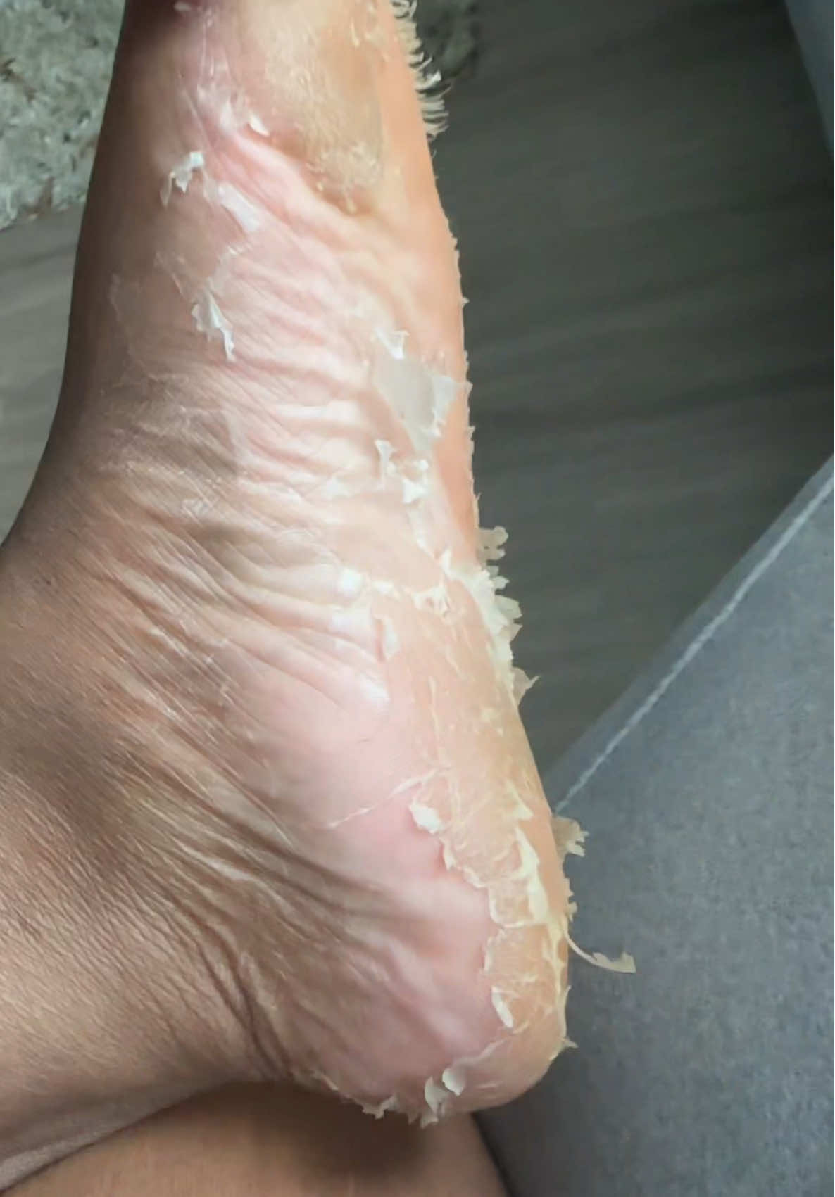 I used this Plantifique foot peel mask 5 days ago and my feet just started peeling 3 days in! It’s already revealing a new layer of soft, smooth skin. If you struggle with dry feet, cracked heels, or rough patches—this is a game-changer. The peeling is so satisfying and actually works! #footpeelmask #plantifiquemask #smoothfeet #callusremover #dryfeetremedy #footcaretips #selfcareathome #tiktokshopfinds #footpeelresults #footmaskreview #deadskinremoval #skincaretools #tiktokseo #exfoliatingfootmask #fyp #tiktokshopcreatorpicks #dealforyoudays 