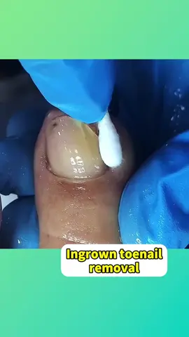 Most Satisfying Ingrown Toenail Removal Ever!🤯 #ingrowntoenail #satisfying #toenailremoval #pedicure #viral #podiatry #foryou 