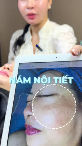 Trả kết quả ca nám nội tiết sau sinh sau 5 tháng điều trị tại O-Derma Center  #Odermacos #Odermacenter #chuyengiaocongnghespa #caophucnguyen #DieuTriNam 