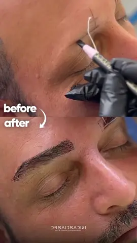 Augenbrauen Transplantation bei Männern so natürlich wie möglich. #eyebrowtransplantation #augenbrauentransplantation #transplantation #augenbrauen #haar #haartransplantation 