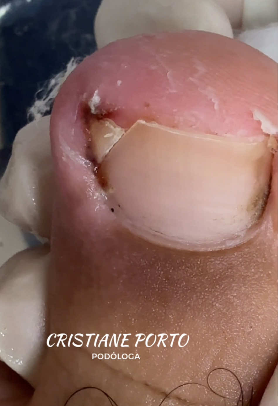 😱| NOSSA, IMAGINA O ALÍVIO ! VOCÊ JÁ TEVE UNHA ENCRAVADA ? . #podologia #satisfying #satisfatório #fyp