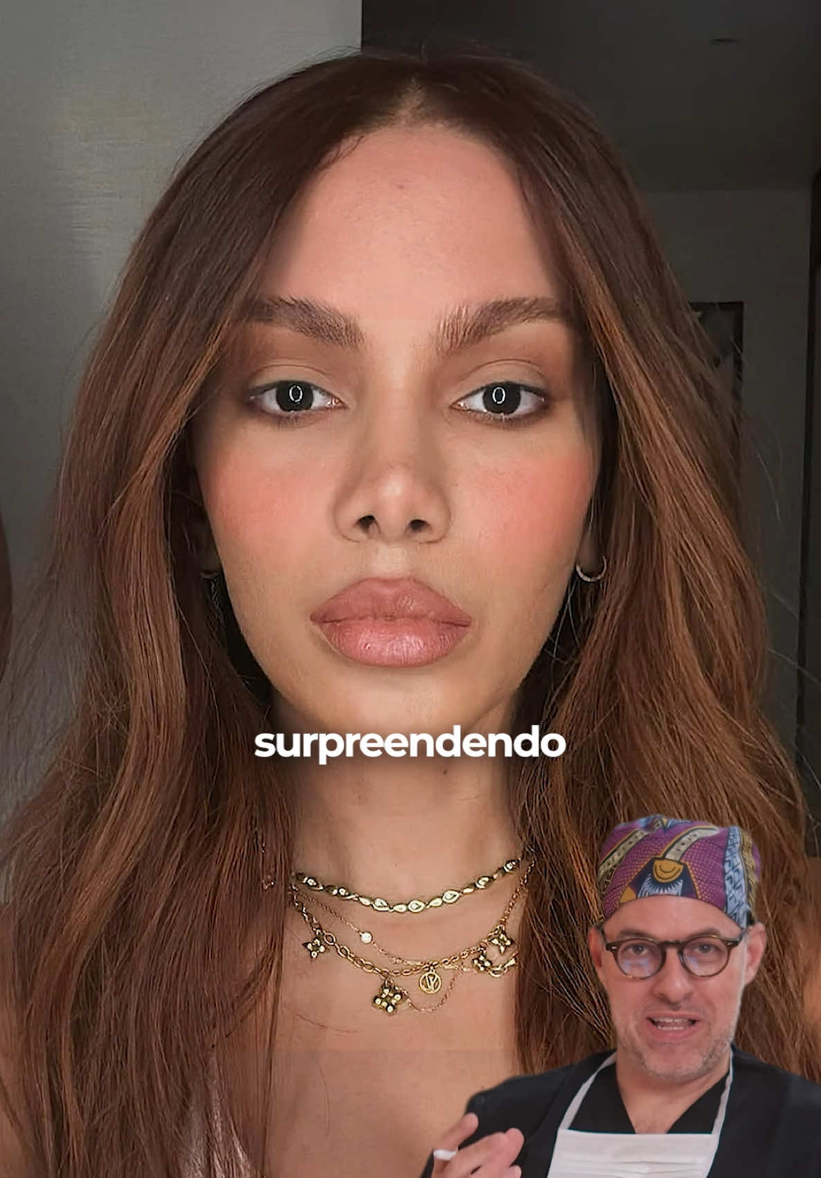 O que você achou dessa transformação da Anitta? 💭 (Responda nos comentários) Minha análise sobre os procedimentos que a Anitta possivelmente realizou, entre eles, a remoção de preenchimentos, um lifting endoscópico nos vetores A e B e um lip lift.  A elevação das sobrancelhas, o encurtamento do lábio superior e o novo contorno nasal sugerem uma abordagem ampla. O lifting endoscópico, feito por incisões ocultas no couro cabeludo, permite esse tipo de resultado, reposicionando elementos profundos sem tensionar a pele. Você faria algo parecido ou optaria por um caminho mais discreto? ⚜️Clinica Kacowicz São Paulo LTDA ⚜️CRM CNPJ: 986803 ⚜️Rua Doutor João Climaco Pereira , 39 – Itaim Bibi  ⚜️Responsável Técnico: Ricardo Doering Kacowicz  ⚜️CRM: 168083 – RQE / SP 49237 ⚜️Agende sua consulta: (21) 96786-1305 #liftingdeepplane #deepplanefacelift #blefaroplastia #anitta #liplift #famosos #antesedepois #rejuvenescimentofacial #facetransformation #cirurgiaplastica