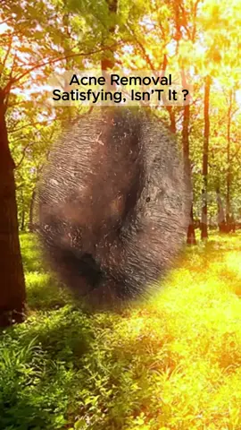 #squeezeyuk #satisfying #pimple #foryou #relax #fyp 