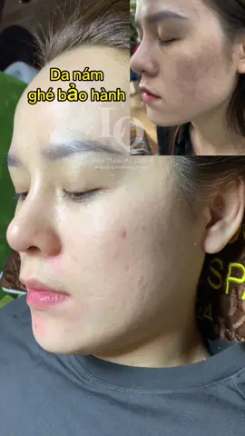 Cập nhật da Nám#chamsocdaseo#chamsocda#chamsocdamun#chamsocdanam#tanbinh#govap #Lequynh#Lqspa#hocnghespa  #chamsocda #lequynhspa #vienthammylqspa #nanmunbangtay #nanmunbangtambong #nanmunbangcay#goidauduongsinh