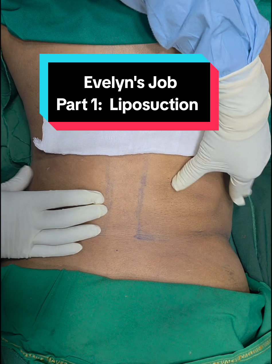 Evelyn’s Body Journey Begins 💫 | Part 1 In this video, we take you behind the scenes as we perform Liposuction to sculpt Evelyn’s midsection and harvest fat for transfer. You’ll also see the fat processing stage — where we purify and prepare her natural fat for the next phase of her transformation: the BBL. This is the art of contouring — tailored, precise, and empowering. 📍Stay tuned for Part 2, where we show the Brazilian Butt Lift (BBL) procedure itself and how we enhance her silhouette with beautiful, natural volume. 📲 Ready to begin your own transformation? Call or WhatsApp 0596038877 to book your consultation at Elixir Clinic. #EvelynsTransformation #LiposuctionJourney #BBLGhana #FatTransfer #BodySculpting #BeforeAndAfter #GlowWithElixir    
