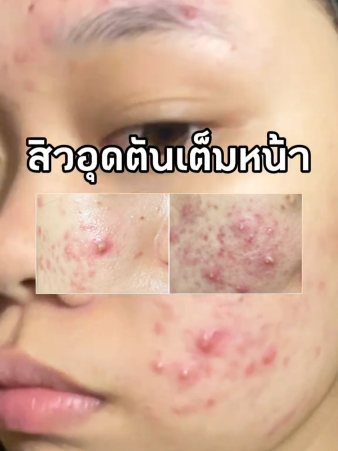 สิวอุดตันเต็มหน้า ไม่ต้องกดให้หน้าช้ำทิ้งรอยอีกต่อไป😱‼️ #peurri #เพียวรี #สิว #เจลแต้มสิวเพียวรี #รีวิวบิวตี้
