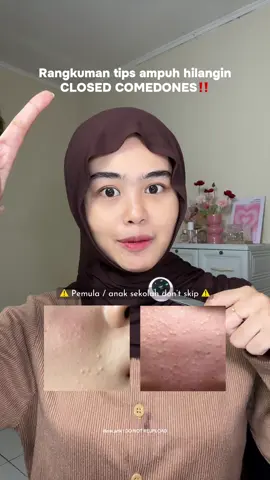 plis initu banyak banget ditanyain di dm😬 aku coba rangkumin yah biar ga pusing 🫶🏻 #closedcomedones #komedo #tipskomedo #skincaretips 