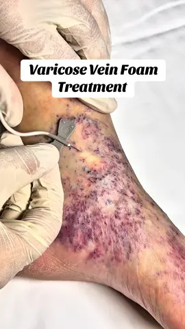 ✔️ Tedavi: Köpük Skleroterapi 📌 Bu görseller bilgilendirme amaçlıdır. ✍️ Hasta onayı alınmıştır. 🧬 Her hastada sonuçlar farklılık gösterir. ‼️Reklam veya yönlendirme amacı taşımamaktadır. 📍 Bu vaka örneğinde, varis şikâyeti olan bir hastamızın tedavi görüntüsü yer almaktadır. 📌 İlgili görsel/video, hastamızın açık rızası alınarak, bilgilendirme amacıyla paylaşılmıştır. Görseldeki işlem sonuçları kişiden kişiye değişebileceğinden, genelleme yapılamaz. Her tıbbi müdahale bireysel değerlendirme gerektirir. 📍 Bu paylaşım, tanı veya tedavi amacı taşımamakta olup; yalnızca toplumu sağlık konularında bilgilendirme amacıyla hazırlanmıştır.İşlem hakkında detaylı bilgi almak isteyenlerin doktoru ile görüşmesi önerilir.. 📍 6698 sayılı Kişisel Verilerin Korunması Kanunu (KVKK) kapsamında hasta mahremiyetine saygı gösterilmiştir.