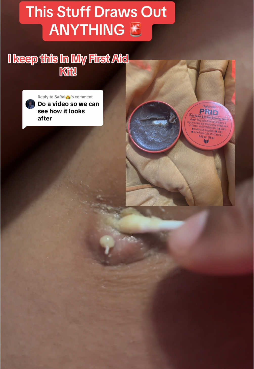 Replying to @SaRai👑 #prid #drawingsalve #salve #splinterremoval #cysticacne #pridsalvecysticacne #hylandspriddrawingsalve #hylandsprid #pridsalve #boil #bartholinabscess #ingrown #ingrowns #boilpopping 