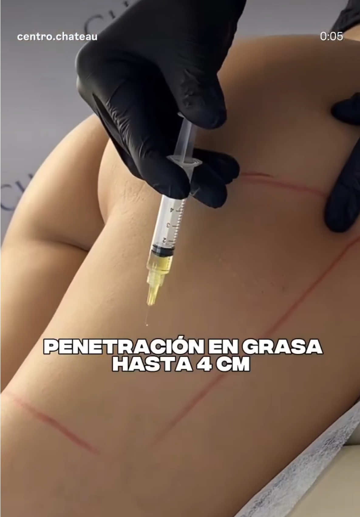 ENZIMAS CORPORALES 🔥🔥 ADIPOSIDAD ✅ #palermo #argentina🇦🇷 #estetik #medicinaestetica #corporal #grasa #grasacorporal 