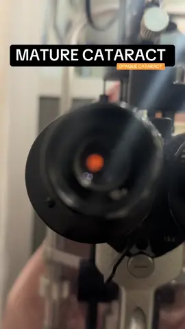 A patient 61yr old has mature Cataract (An opaque cataract refers to a cloudy or opacified lens of the eye, which scatters or blocks light from reaching the retina, leading to vision problems)#syedsonseyeclinic #syedsonsoptical #optometristsyedzain #cataract #information #VisionCare #awareness #optometristassistant #vision #headaches #diagnosis #treatment #free #optometry #cararactsurgery 