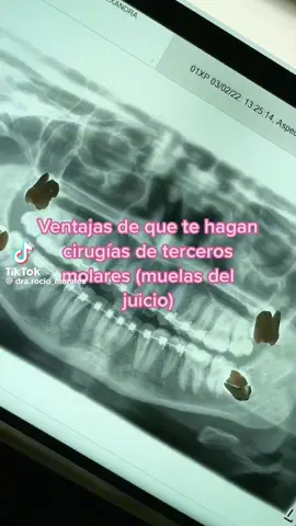 Las muelas del juicio pueden ser más que una molestia. Afectan al hablar, comer e incluso moverse con normalidad. Aunque no podemos evitar que aparezcan, sí podemos actuar a tiempo: ✔️ Prevenir dolor y molestias ✔️ Evitar daño a otros dientes ✔️ Anticipar infecciones y complicaciones ✔️ Extraerlas antes de que erupcionen Miremos Profundo y cuida tu salud bucal con Mora Pavic. Agenda HOY tu evaluación en Morapavic.cl o llamando al 600 570 0063