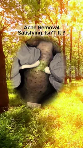 #squeezeyuk #satisfying #pimple #foryou #relax ##fyp 