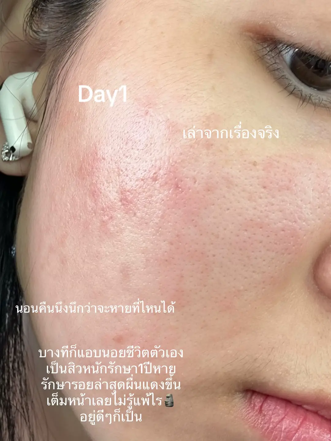 #เซ็บเดิร์ม #ผื่น #ผื่นคัน #ผื่นขึ้น #รักษาผื่น 