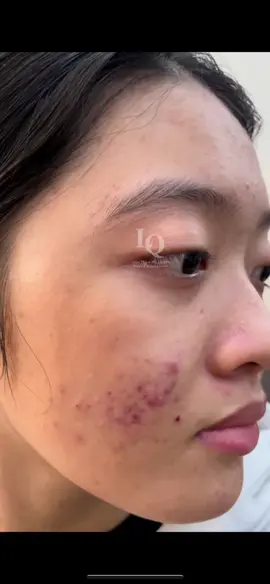 Cập Nhật da Mụn #chamsocdamun#chamsocdaseo#chamsocdanam#tanbinh#govap#Lequynh#Lqspa#hocnghespa  #chamsocda #lequynhspa #lequynhsp#lqspabeautyacdemyahcm#vienthammylqspa #nanmunbangtay #nanmunbangtambong #nanmunbangcay#goidauduongsinh