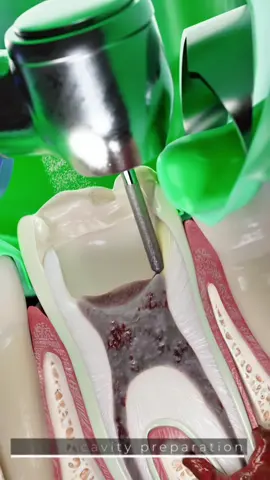 How dental plaque triggers tooth decay? Why root canals are needed? Part 2 Did you know that untreated dental infections can spread deep into the root canals, risking tooth loss?   Here’s how a root canal saves your tooth: 🔺Rotary nickel-titanium instruments precisely remove infected pulp from all canal sections (coronal, middle & apical).   🔺Continuous sodium hypochlorite irrigation kills bacteria and flushes out debris.   🔺The apical zone is meticulously cleaned to eliminate bacteria from the root tip and create a seal for the filling.   💡 Key steps in advanced endodontics: ✔️ Working length measurement ensures precise treatment up to the root apex.   ✔️ Irrigant activation boosts disinfection for long-term success.   ✔️ Canals are dried with sterile paper points before sealing.   📌 Watch the full video about root canal treatment now on our YouTube channel!  #dentistry #oralhealth #rootcanal #endodontics #dentalplaque #toothdecay #3D #3Danimation #3Dmedicalanimation #3danatomy #medstudents #medicaleducation #anatomy #pathology #3danatomy #digitallearning #humanbody 