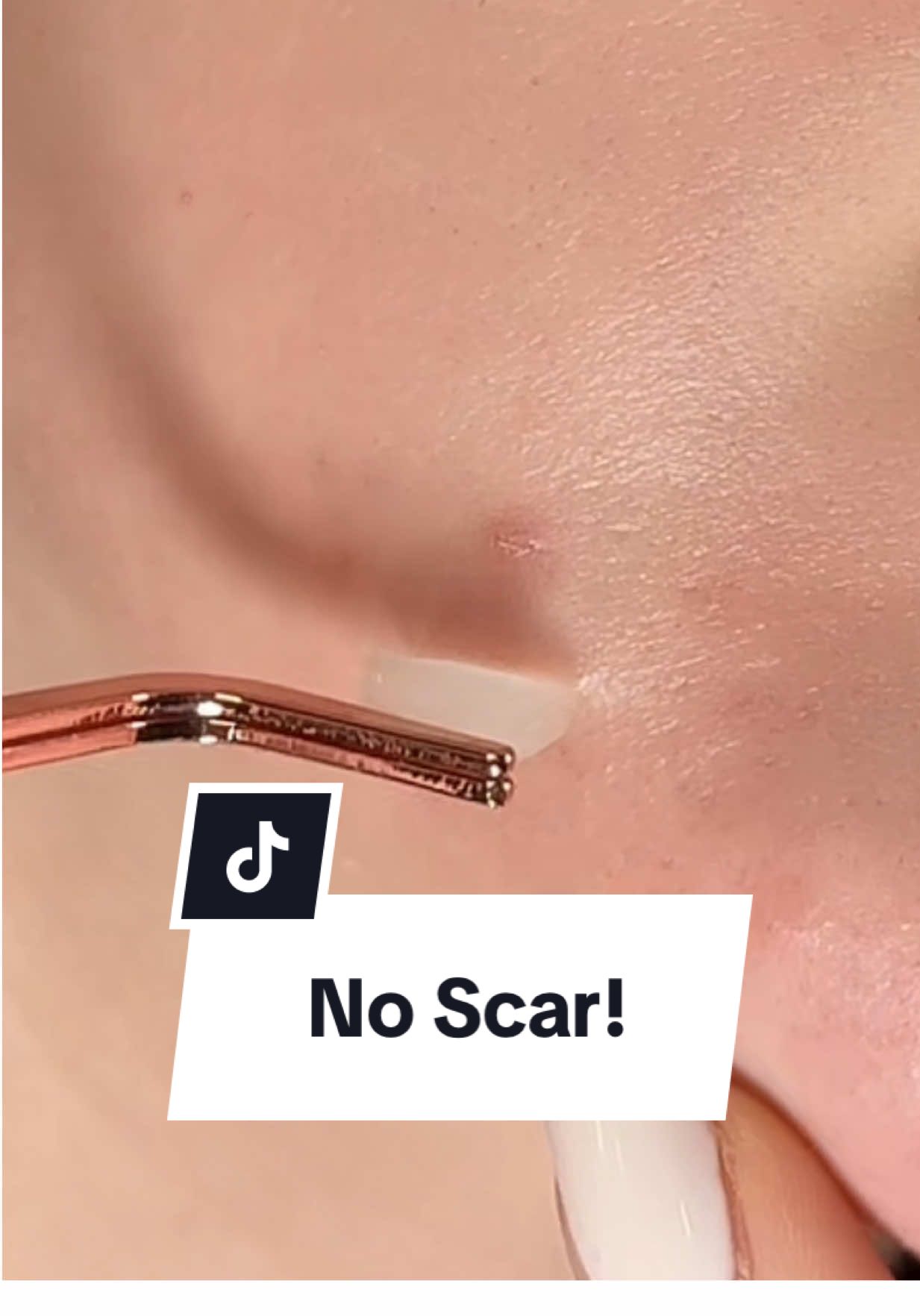 How i fix my pimples without popping! Best hack ever that leaves no scar  @SKIN1004 US #acnescar #pimpleremover #acne #skincareviral #skinhacks #kbeauty #skin1004 #pimplepatch #acneskincare #extractions #acnetips #acnecare #hormonalacne #centella #teatrica #centella #pimpplepopper #skincareroutine #koreanskincare #skincareproducts