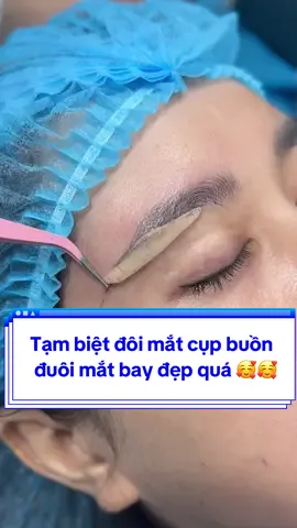 Tạm biệt đôi mắt cụp buồn  đuôi mắt bay đẹp quá 🥰🥰#Tuyết_Diamond #videoviralitiktok #xuhuong #Khâu_Rút_Chỉ #Nâng_cung_chân_mày #Mí_đẹp #