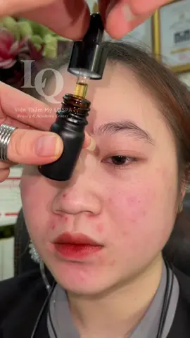Peel tại nhà #chamsocdamun#chamsocdaseo#chamsocdanam#tanbinh#govap#Lequynh#Lqspa#hocnghespa  #chamsocda #lequynhspa #lequynhsp#lqspabeautyacdemyahcm#vienthammylqspa #nanmunbangtay #nanmunbangtambong #nanmunbangcay#goidauduongsinh