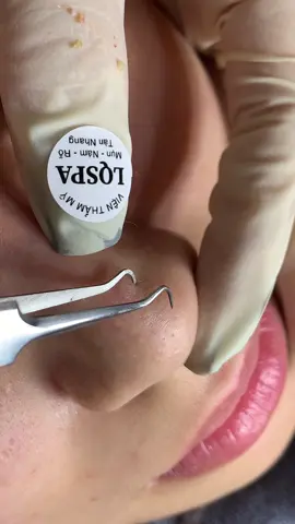 Bứt#chamsocdaseo#chamsocda#chamsocdamun#chamsocdanam#tanbinh#govap #Lequynh#Lqspa#hocnghespa  #chamsocda #lequynhspa #vienthammylqspa #nanmunbangtay #nanmunbangtambong #nanmunbangcay