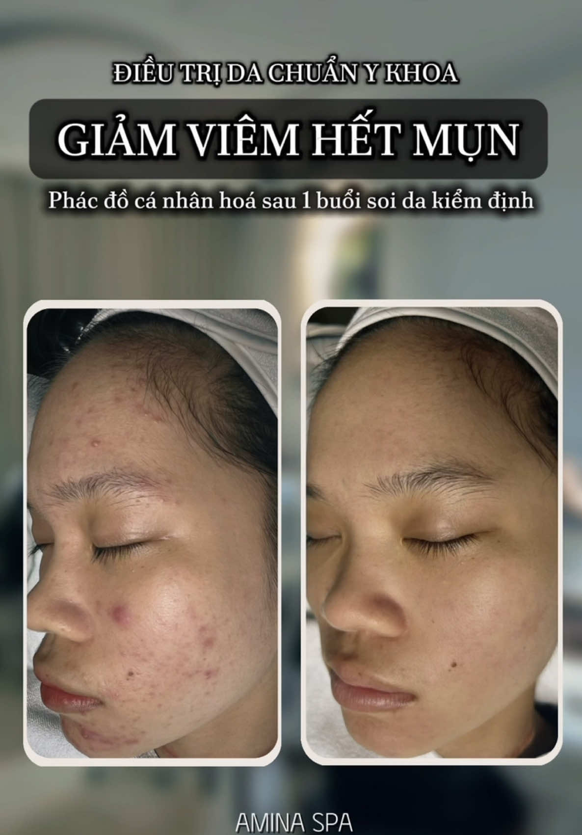 mụn ko còn là nỗi lo sợ, hãy em team chúng mình. #aminatrimunvungtau #nanmun #peelda #695truongcongdinh #mun 