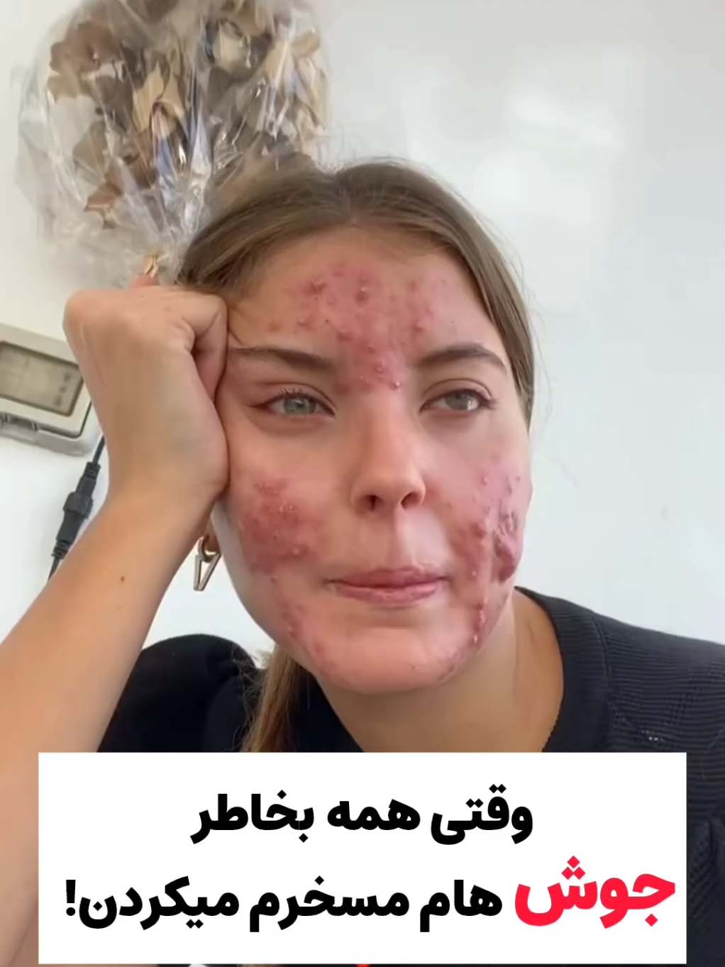 اگه تو هم از ماسک های خونگی برای رفع جوش هات خسته شدی  کافیه عدد ۷ رو برام کامـ نت کنی تا مشاوره رایگان بشی و من یک محصول ضدجوش مخصوص خودت بهت معرفی کنم تا برای. همیشه از دست جوش هات خلاص شی🌸😍🧖🏻‍♀️ اگه به پوست و موهات اهمیت میدی پیجمو فالو کن🥰