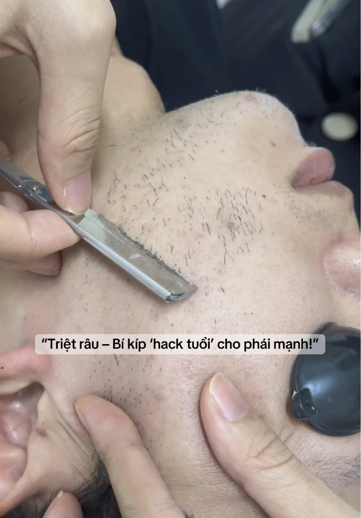 Râu cứng đàu cũng rụng ngay chỉ sau 1-2 lần triệt 👍👍 #CapCut #camispadanang #triệtlôngvĩnhviễn #xuhuong #ilovetiktok #triệtlônglạnhđànẵng #spauytindanang #triệt_râu_cho_phái_nam 