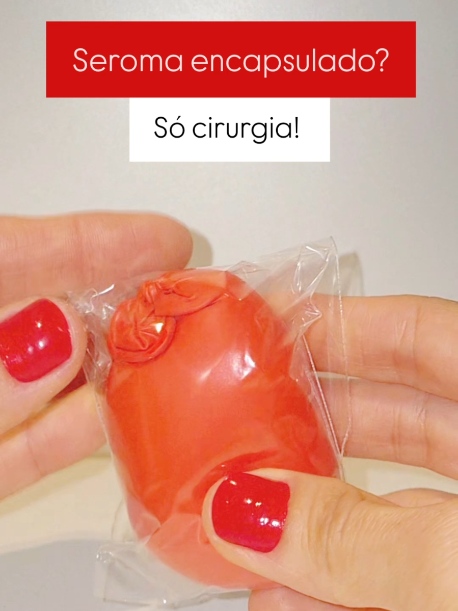 Nem tudo que faz volume é fibrose — e nem tudo sai com mobilização! O seroma é um acúmulo de líquido pós-cirúrgico, formando um bolsão. Se não for puncionado logo, o corpo cria uma cápsula (tipo uma ‘bolsa blindada’) ao redor. A fibrose ao redor até pode ceder com terapia manual. Mas a cápsula? Não sai — só cirurgia resolve. Por isso, detectou seroma?  Cirurgião, punção e acompanhamento — quanto antes, melhor. Avaliação certa = resultado certo. Marca quem ainda acha que mobilização resolve tudo! Erika Nunes 🤲 Crefito-3: 102.883-F Cicatrização • Fibrose • Pós-operatório com resultado 💙