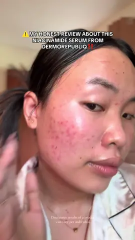My acne journey using niacinamide serum from dermorepubliq #dermorepubliq#dermorepubliqserum #niacinamideserum #serum #acnetreatment 