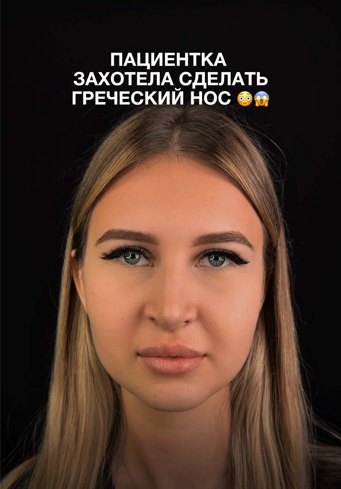 Результат спустя 2 месяца  #рино #ринопластика #риносептопластика #допосле #докторайрапетян 