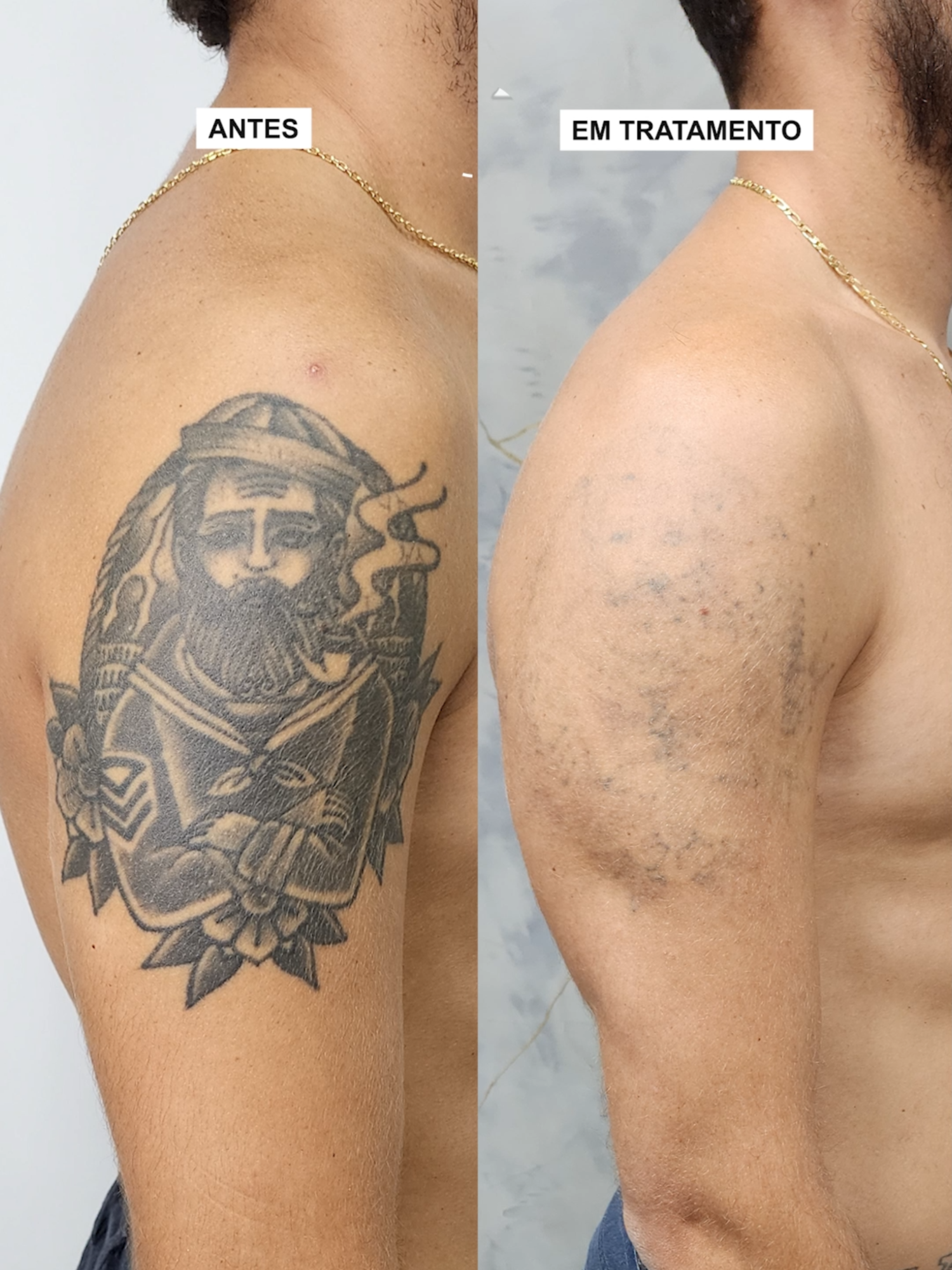 ⚓ Antes e depois do tratamento de uma tatuagem de marinheiro bem pigmentada e localizada no braço. Foi realizado em sessões programadas, respeitando o intervalo ideal para a regeneração da pele e o clareamento progressivo do pigmento. Utilizamos tecnologia de ponta, com parâmetros ajustados conforme a resposta da pele e o comportamento da tinta ao longo das sessões. O resultado é visível e mostra o avanço seguro do processo de remoção até aqui, sempre com acompanhamento profissional. 💡 👉 Se interessou? Envie uma foto da sua tatuagem no WhatsApp e realize sua avaliação personalizada! #remoçãodetatuagem #tattooremoval #helltattoo #fyp