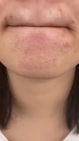*Tu as des imperfections au visage ou Ta peau grasse te gâche la vie ? 😩*   Ce stick magique à 9€ nettoie, hydrate et resserre les pores en 10 minutes chrono ⏱✨   Zéro effort, zéro gâchis, 100% glow ! 🌿   👉 Teste-le maintenant, ta peau va kiffer #commander  #livraisongratuite  #paiementalaivraison  #zinder  #maradiniger🇳🇪  #227🇳🇪  #tiktoknigerienne🇳🇪 