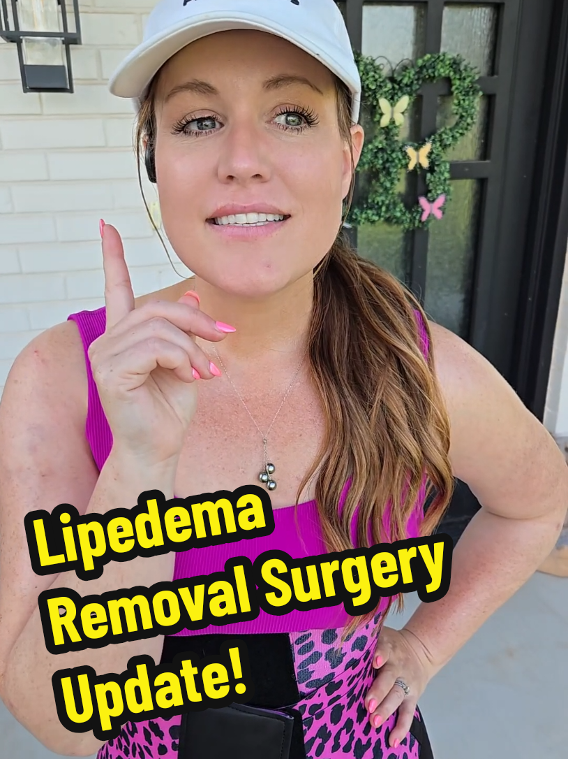 Lipedema Removal Surgery Update. #lipedema #lipedemaremoval #lipedemasurgery #lipedemalegs #lipedemaarms #brachioplasty #lipedematrunk #lipedemasurgeon #drazouzdallas #samanthawlipedema 