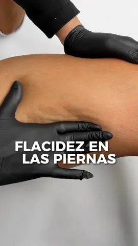 No más piel de naranja o piernas con hoyuelos de celulitis con este tratamiento logra una piel firme y tonificada #anticelulitico #celulitis #celulitisygrasa #celulite #flacidez #flacidezcorporal #piernas #piernasfuertes #enzimas #emsculpt #tonificar #tonifica #pieldenaranja #pieldenaranja🍊 #hoyuelos #grasaenpiernas #celulitispiernas #orangeskin #radiofrecuencia 