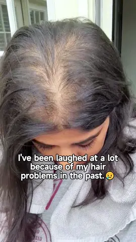 If you have #thinninghair or lots of #hairfall ，you should really try #remimpi ‘s anti-hair loss shampoo — it works great based on my experience！#bald #hairgrowth #dealsforyoudays 