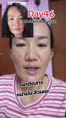 มาส่งกำลังใจ คนเป็นฝ้าหนาหน้ามันเป็นสิว #ฝ้าติดสาร #ฝ้าแดด #สิวฝ้ากระจุดด่างดํา #พี่ปูที่เคยเป็นฝ้าหนาๆ #พี่ปูหัวฟู 
