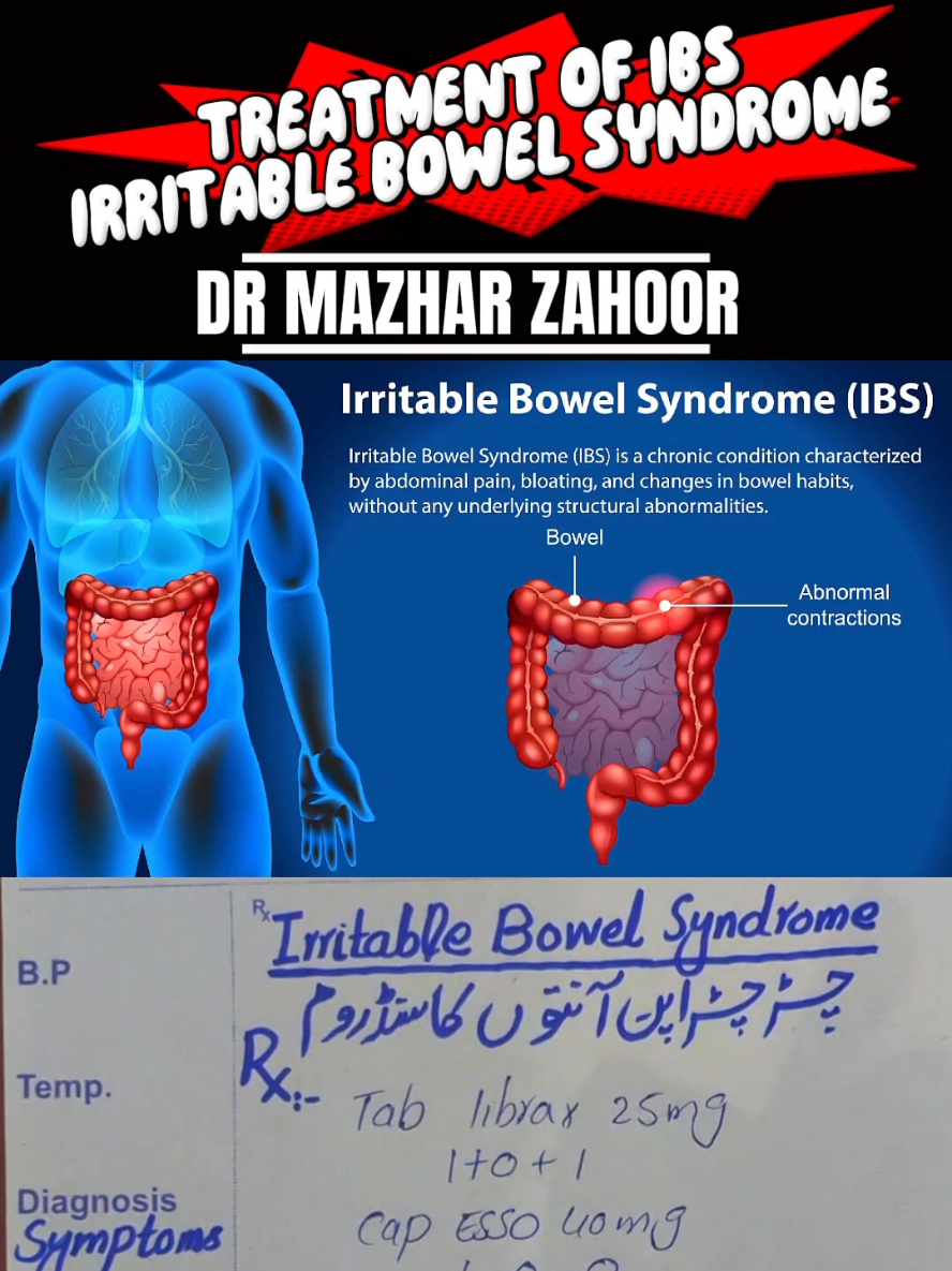Treatment and Management of Irritable Bowel Syndrome (IBS) involves a multidisciplinary approach that includes lifestyle changes, dietary modifications, medications, and psychological support depending on the type (IBS-C, IBS-D, IBS-M). 🔍 Types of IBS IBS-C – constipation-predominant IBS-D – diarrhea-predominant IBS-M – mixed (alternating constipation and diarrhea) ✅ General Management Principles 1. Lifestyle Modifications Regular exercise (30 mins daily) Adequate sleep Stress reduction (meditation, yoga, cognitive behavioral therapy) Hydration 2. Dietary Management 🔹 Low FODMAP Diet Avoid fermentable carbs: Onions, garlic, apples, beans, milk, wheat 🔹 Increase soluble fiber (for IBS-C) Psyllium husk (ispaghol) Oats, bananas, carrots 🔹 Avoid trigger foods Caffeine, spicy foods, fatty meals, artificial sweeteners 💊 Pharmacological Treatment 🔹 For IBS-C (Constipation-predominant) Fiber supplements (Psyllium) Laxatives (Polyethylene glycol, Lactulose) Lubiprostone or Linaclotide (in severe cases) 🔹 For IBS-D (Diarrhea-predominant) Loperamide (Imodium) Rifaximin (antibiotic for gut flora balance) Bile acid binders (cholestyramine) Eluxadoline (moderate to severe cases) 🔹 For IBS-M (Mixed type) Symptom-targeted treatment Combination of above based on current symptom 🧠 Psychological Therapies Cognitive Behavioral Therapy (CBT) Hypnotherapy Antidepressants  Tricyclics for IBS-D SSRIs for IBS-C or anxiety component 📋 Patient Education Reassure that IBS is chronic but not life-threatening Symptom diary to track triggers Regular follow-ups to monitor and adjust therapy #IBSandAnxiety #StressRelief #MindGutConnection #RelaxForIBS #IBSMentalHealth #MeditationForIBS #CBTForIBS  #LowFODMAP #IBSDiet #GutHealing #HealthyGut #BloatingRelief #StomachIssues #IBSFriendly #FiberFoods #StomachCare #IBSRecipes  #IBSDoctor #IBSRemedies #IBSMedication #Gastroenterology #Laxatives #ProbioticsForIBS #IBSManagement #IBSAdvice #IBSCure  #HealthTips #MedicalTikTok #TikTokDoctor #DigestiveTips #StomachPainRelief #HealthyLifestyle #ChronicIllness #WellnessTok 