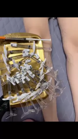 __ 20cc tiêm Chân thẳng,💉 Chữa khuyết điểm chân vòng kiềng cho e KH iu dấu