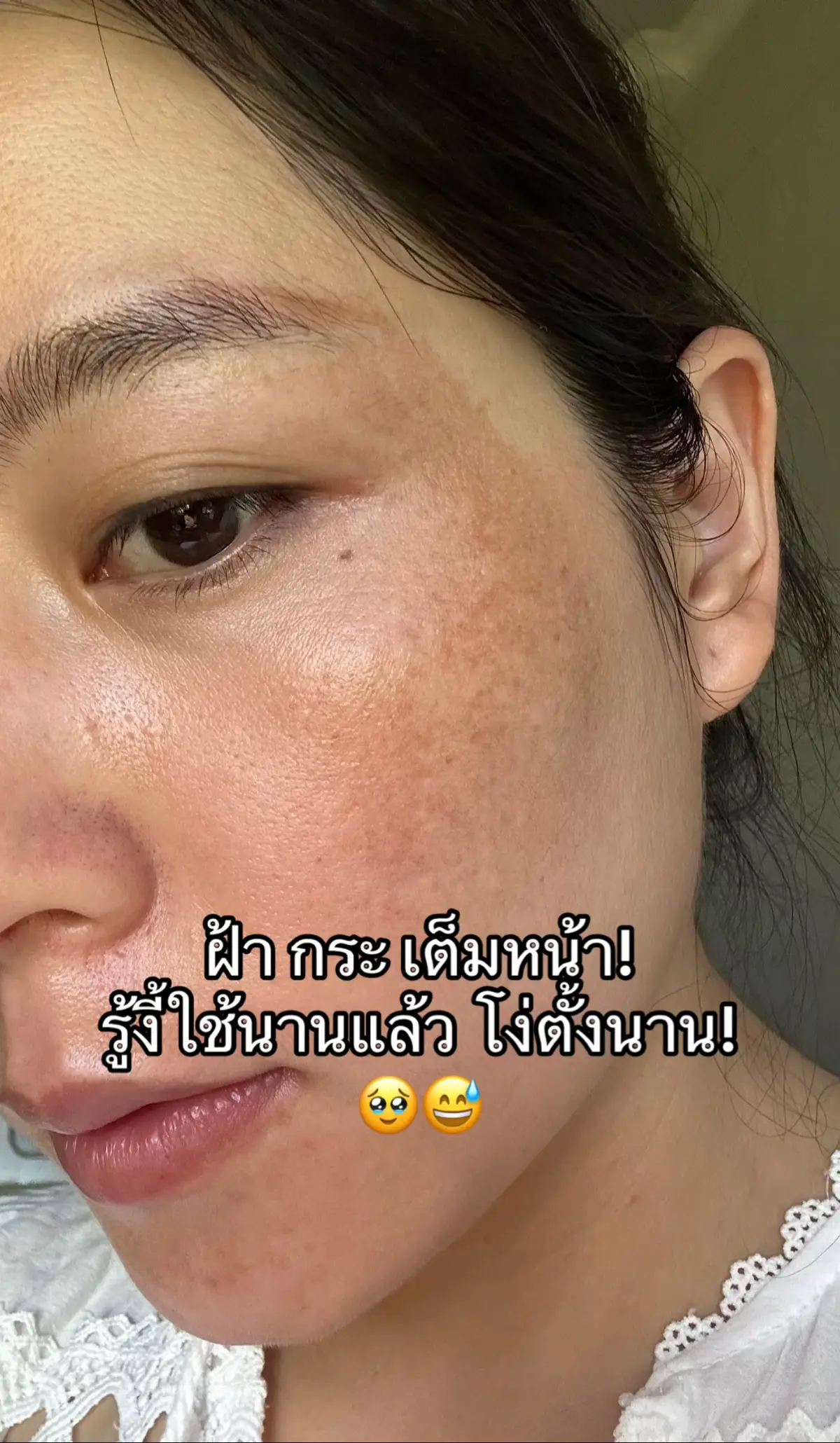 #ใช้ดีบอกต่อ #ฝ้าแดด #ฝ้า #เซรั่มผลัดเซลล์ผิวหน้า 