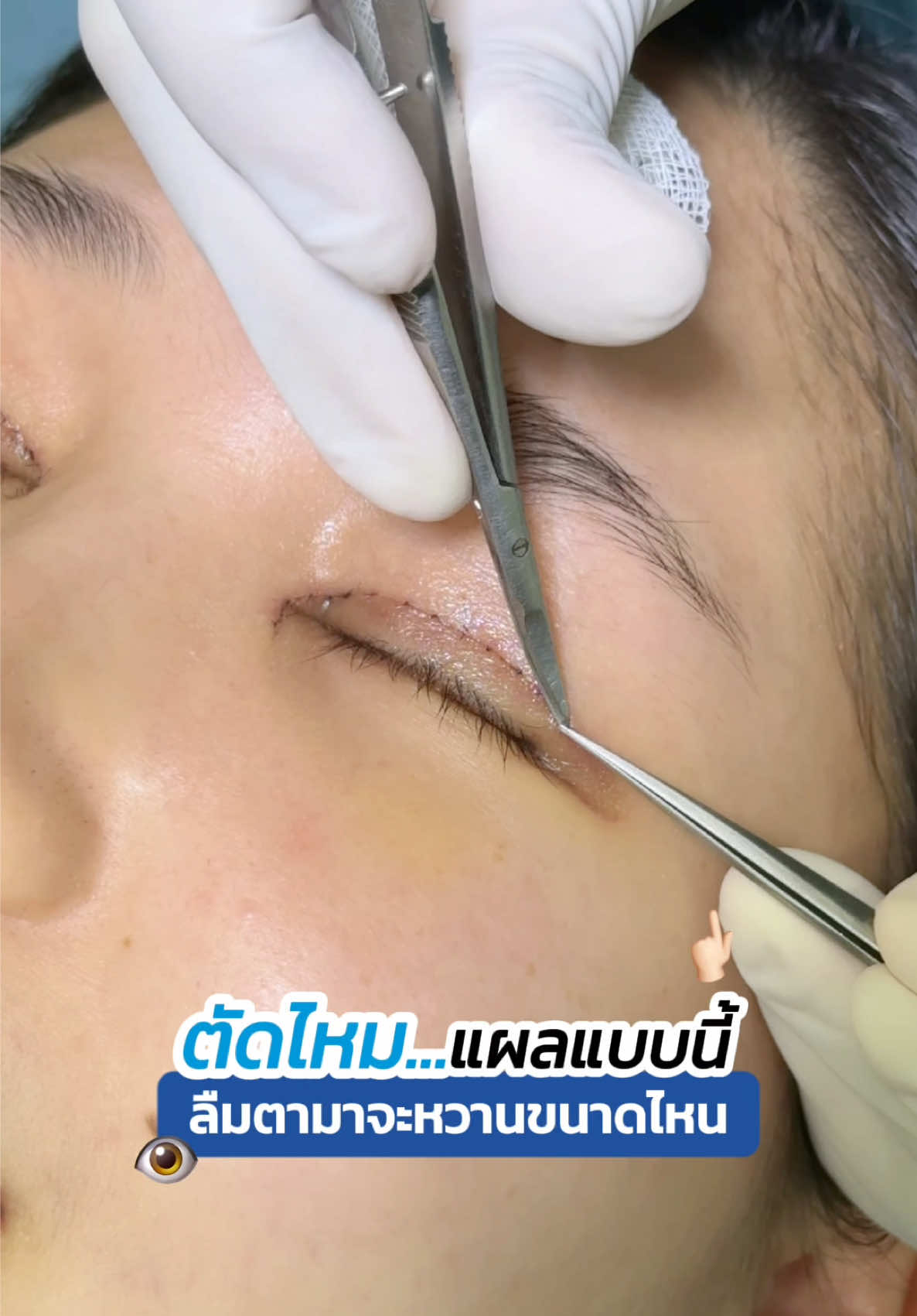 ✂️ ตัดไหมตาสองชั้น แผลแบบนี้ ?? แผลจะสวยขนาดไหน ⁉️ #รีวิวตาสองชั้น  #จักษุแพทย์ #skyclinic #ทำตาที่ไหนดี #หมอสกาย #ศัลยกรรมตา 