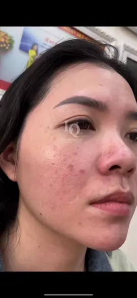Cập Nhật Mụn Sạm #chamsocdamun#chamsocdaseo#chamsocdanam#tanbinh#govap#Lequynh#Lqspa       